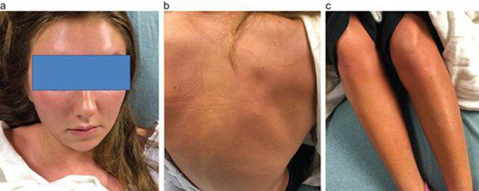 Can Breast Abscess Lead The Patient To ICU?