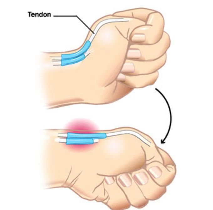 extensor pollicis longus test