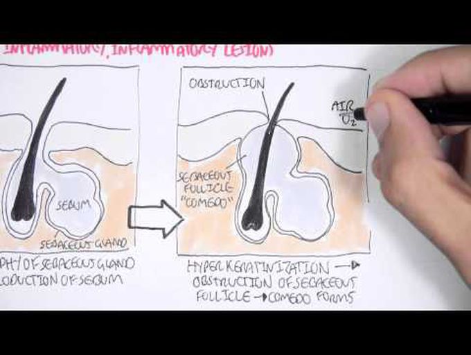 Acne Pathophsyiology