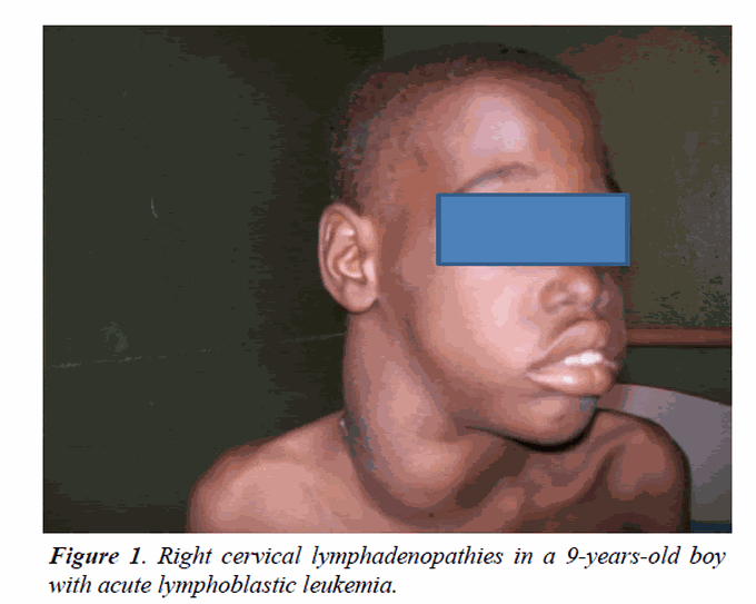 Clinical Presentation of Child With Leukemia