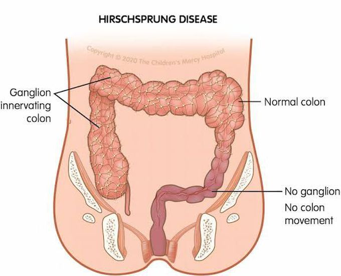 Treatment of Hirschsprung