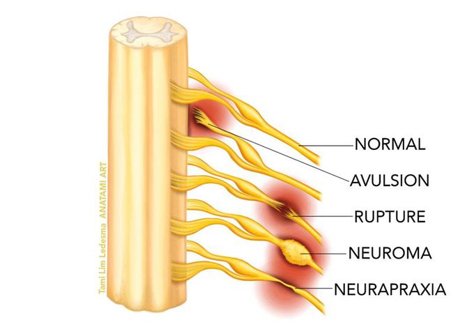 Neuropraxia