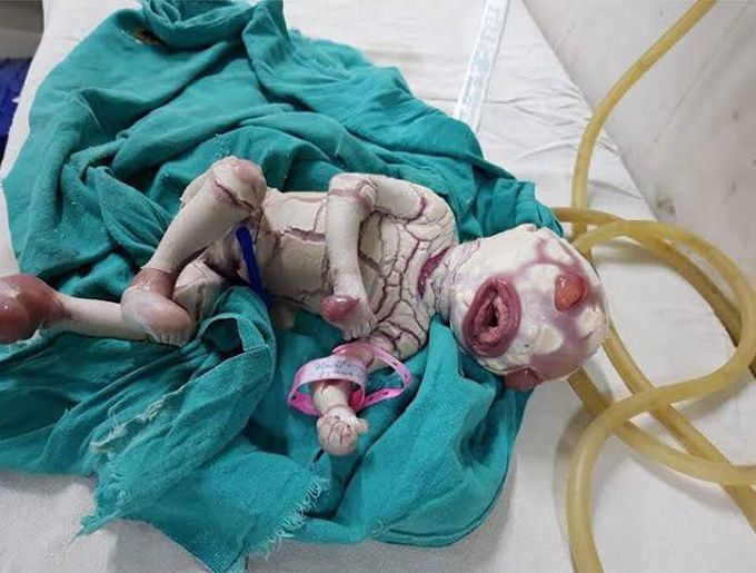 Harlequin Fetus- A severe form of ichthyosis