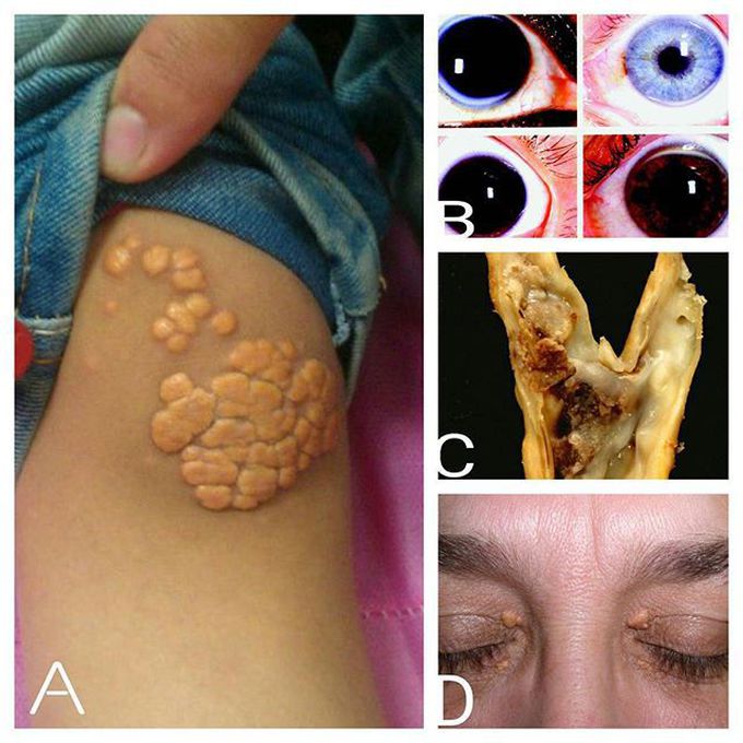 Hyperlipidemia Signs