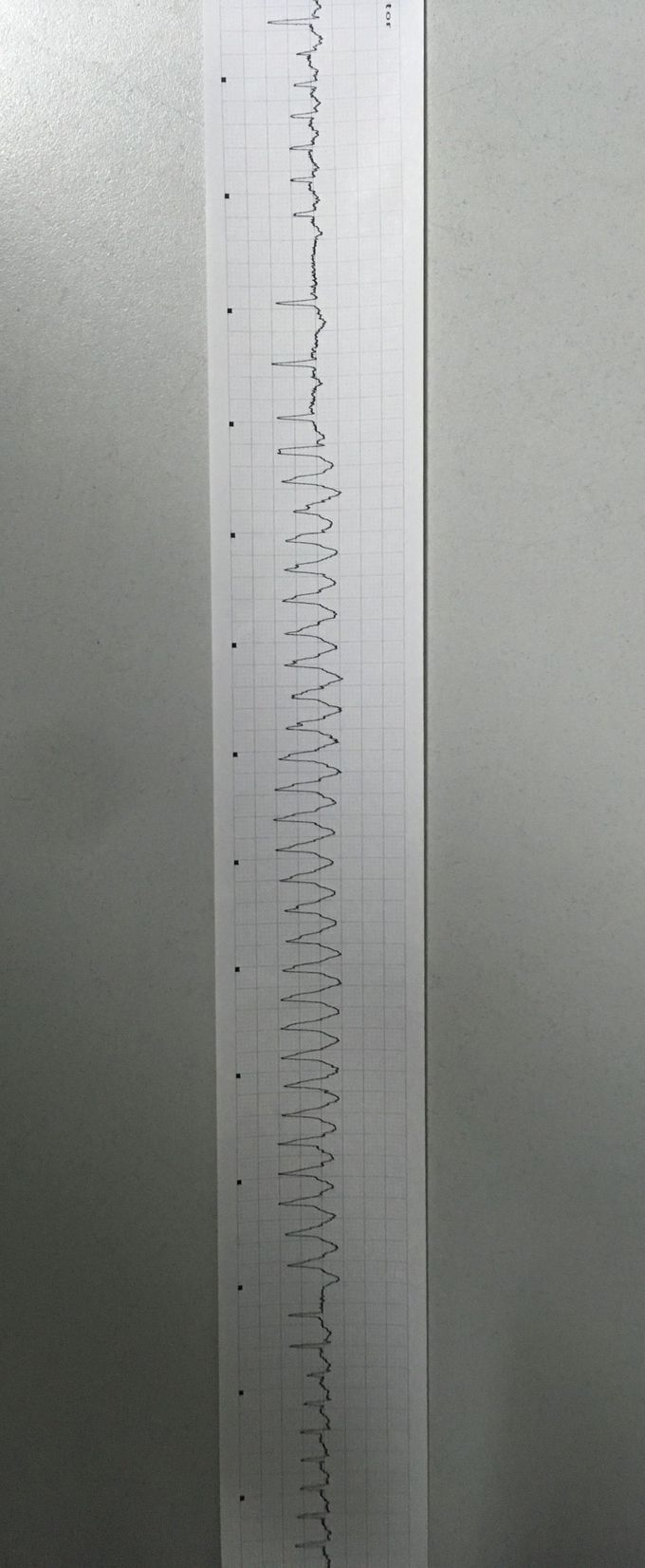Ventricular tachycardia