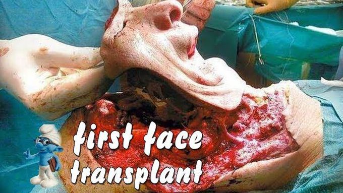 The World's First Face Transplant 🎭
