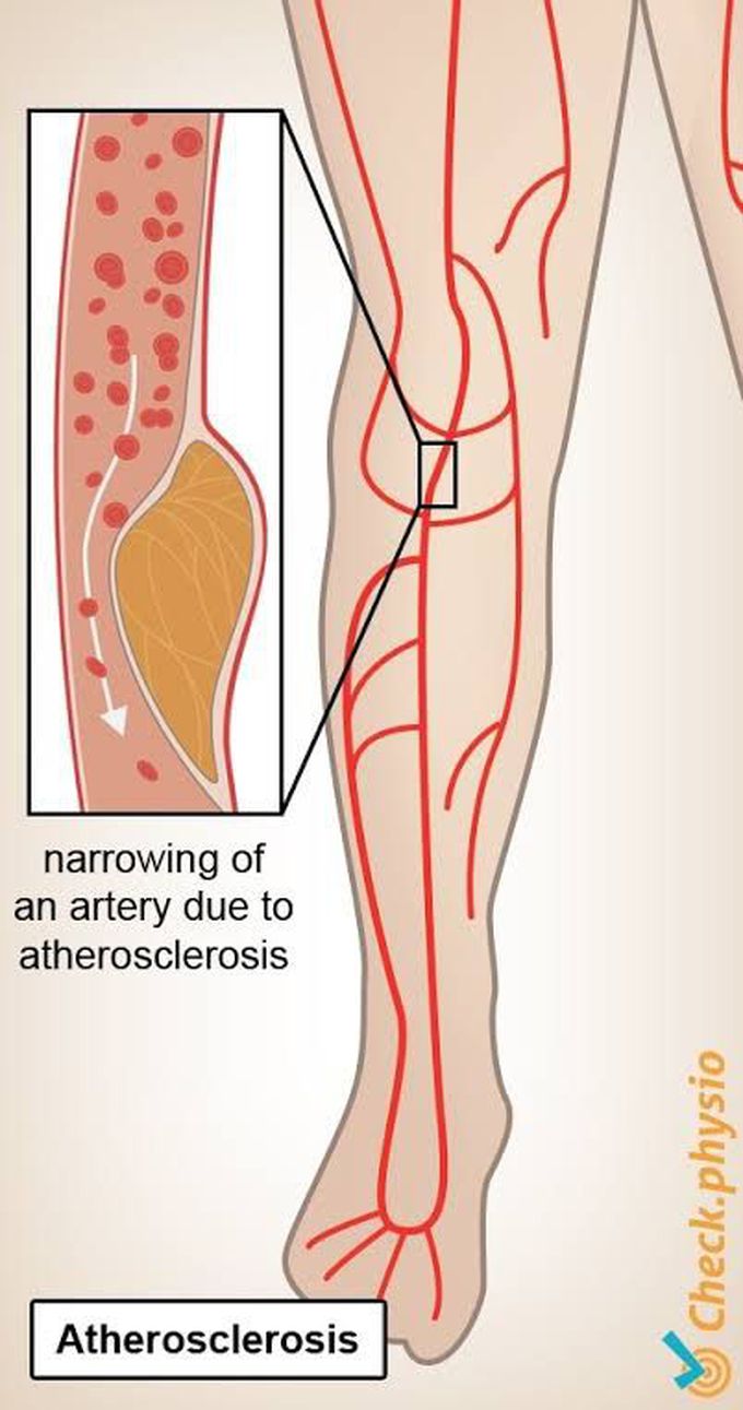 Prevention from intermitten claudication