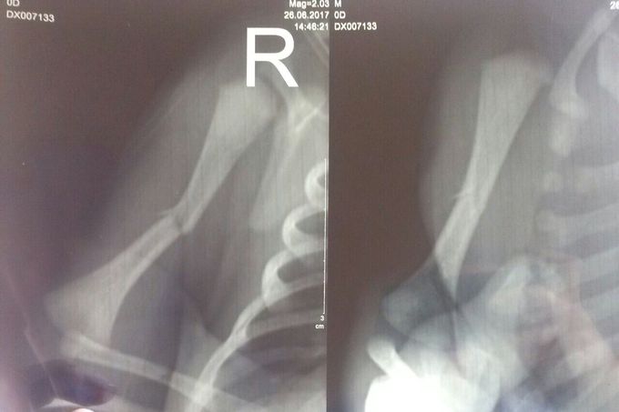 fracture of humerus in the newborn