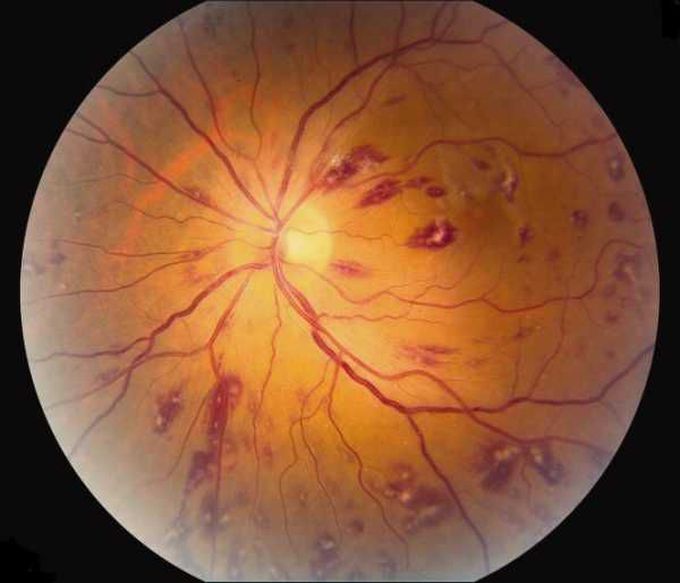 Roth spots in infective endocarditis