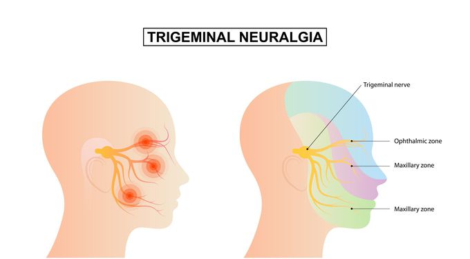 Trigeminal neuralgia