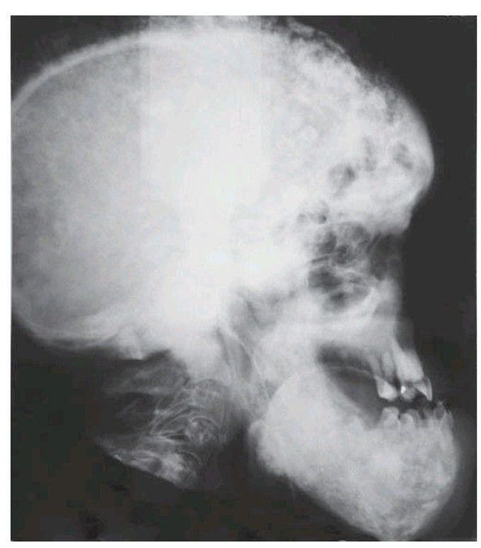 Paget’s disease.