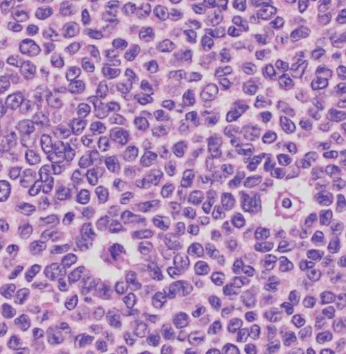 Tumors with coffee bean shaped nuclei