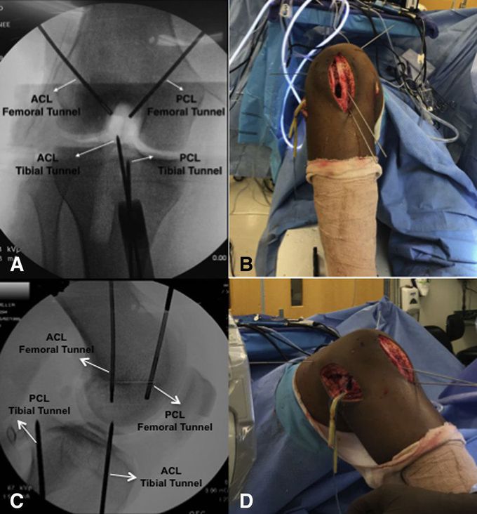Intraoperative images with corresponding C-Arm images of right knee. (A-D) Check guide pin positions and directions to prevent possible malpositioned tunnels and tunnel convergence. 