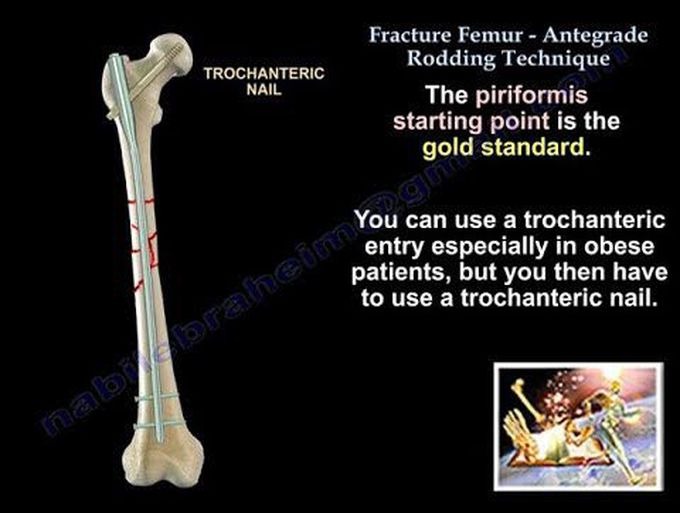 Fracture Femur Antegrade Rodding - Everything You Need To Know - Dr. Nabil Ebraheim