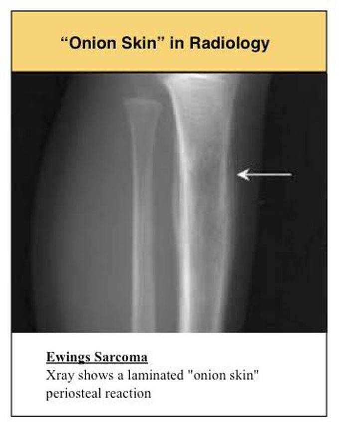 Characteristic feature of ewing sarcoma
