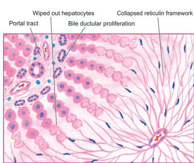 Fulminant hepatitis.