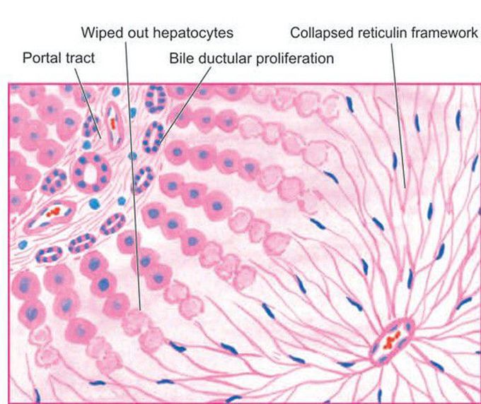 Fulminant hepatitis.