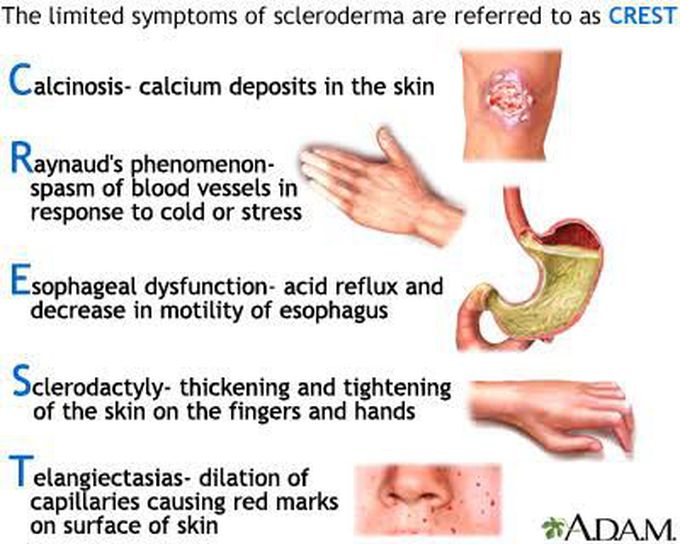 Symptoms of crest syndrome