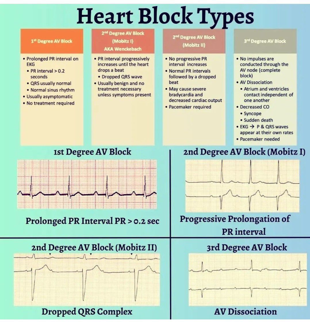 Heart Block Types MEDizzy