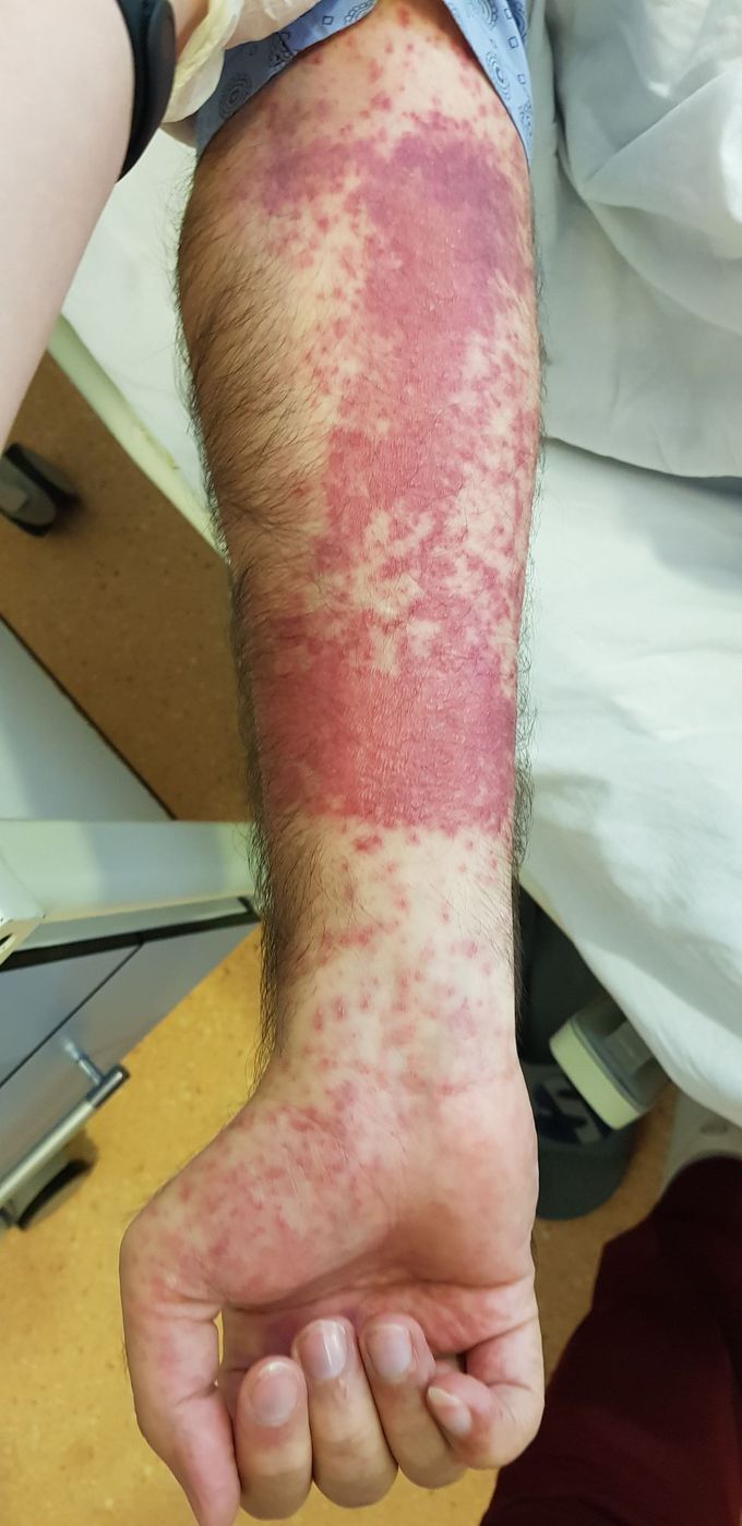 Allergy due to carbapenems