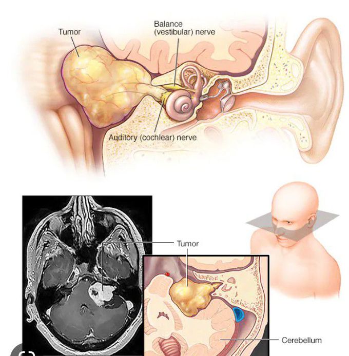 Ear tumor