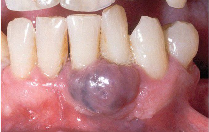 Peripheral Giant Cell Granuloma