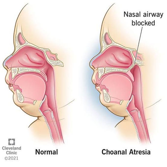 Choanal Atresia