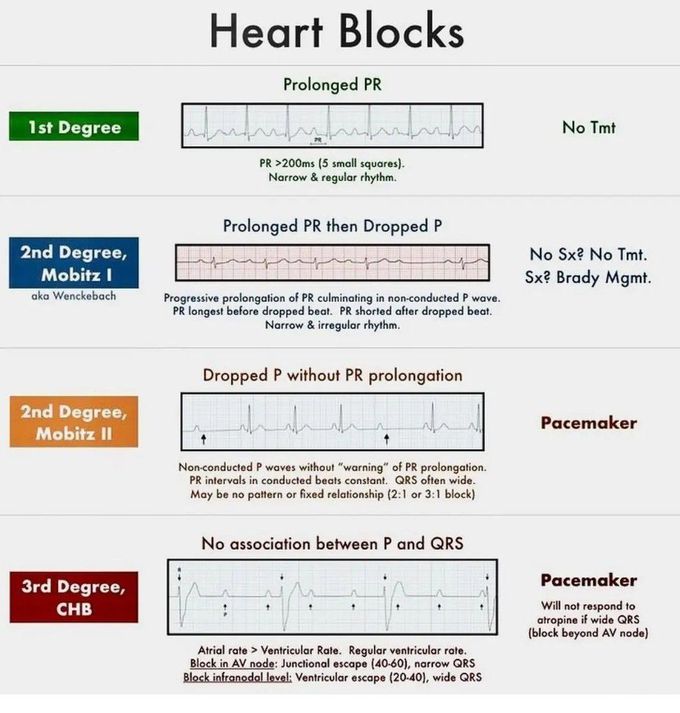 Heart Blocks