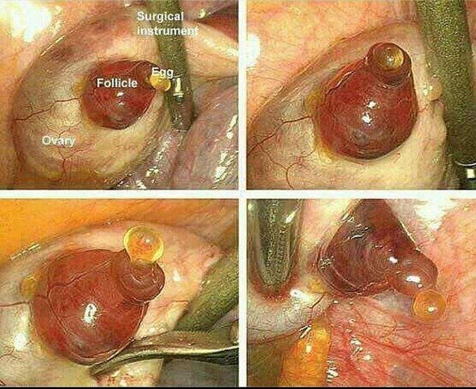 A beautiful picture of ovulation seen on laproscopy