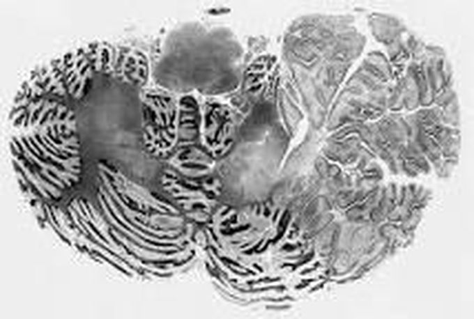 Lhermite duclose disease