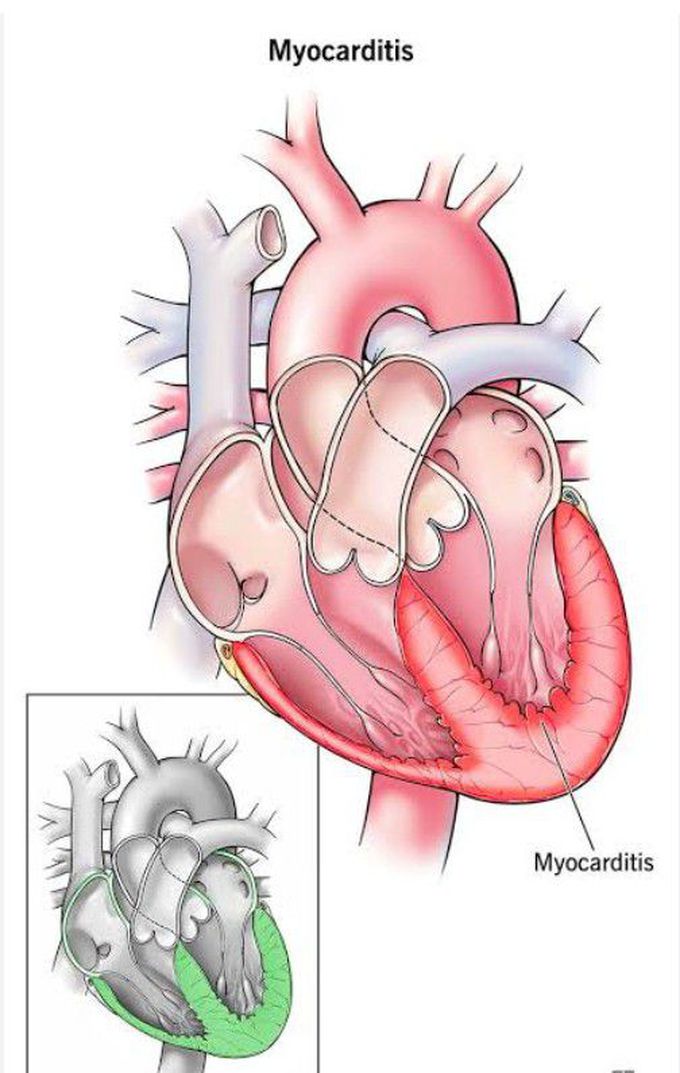 Myocarditis