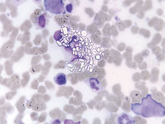 Cystine Crystals in Bone Marrow