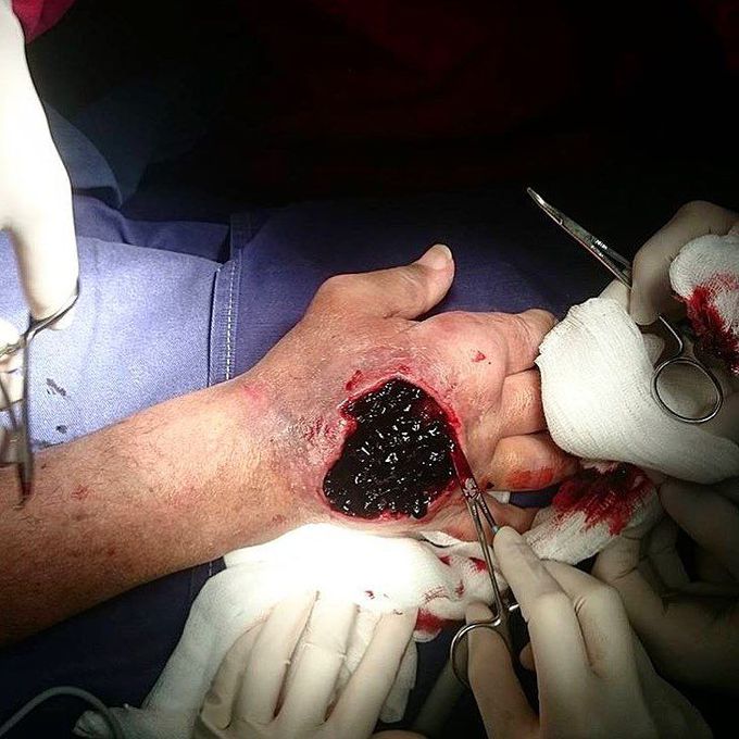 A hematoma organized on the back of hand with skin necrosis after puncture in anticoagulated patient