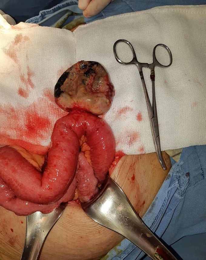 Gangrenous and perforated Meckel's diverticulum! 