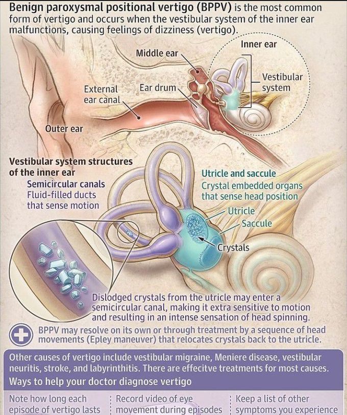 Benign paroxysmal positional vertigo