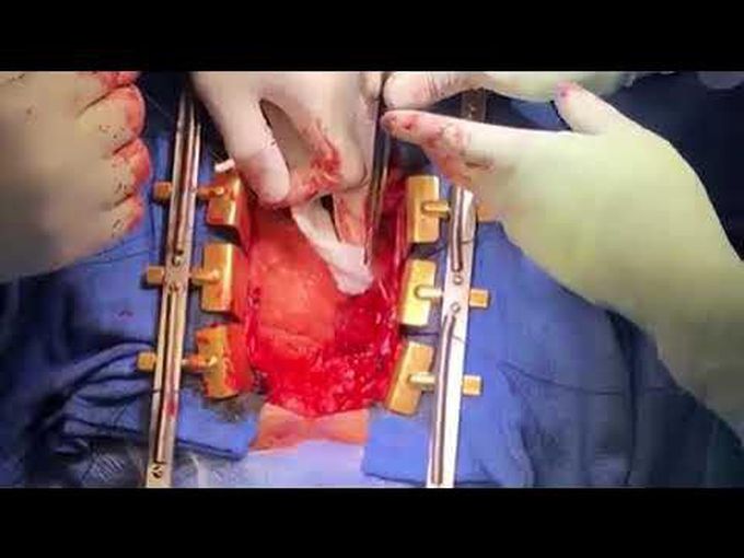 Removal of an Intracardiac Cement Embolism