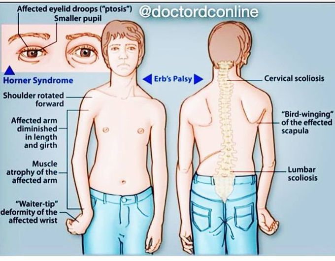 Erb's Palsy and Horner Syndrome