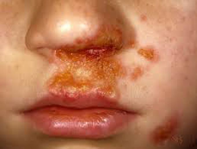 Impetigo