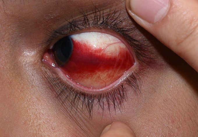 Subconjunctival Hemorrhage