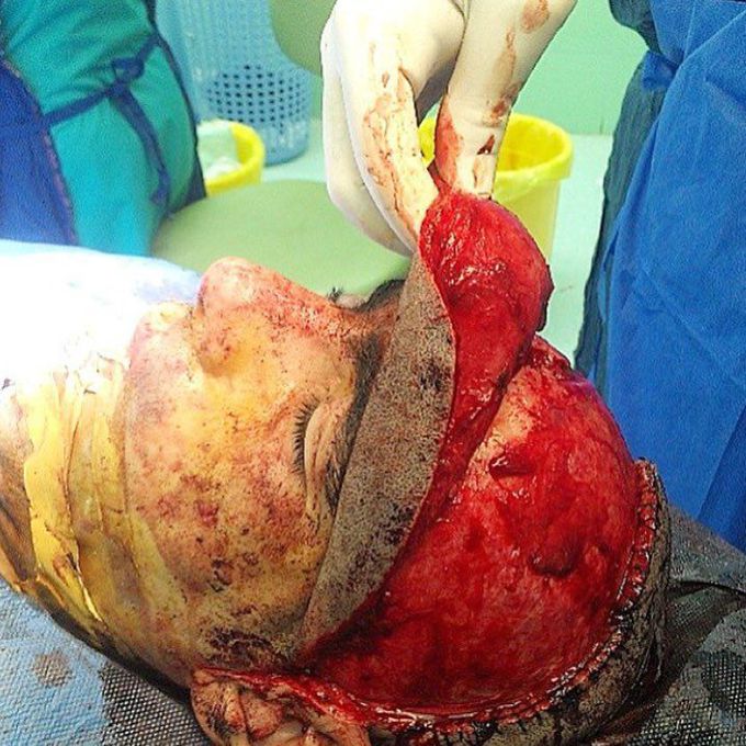 Reconstruction of frontal bone fracture