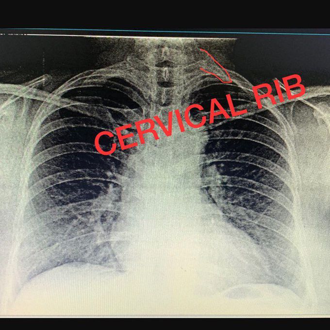 Cervical Rib