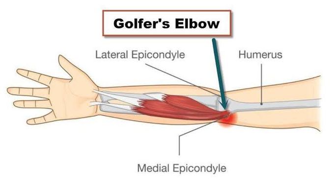 Golfers elbow