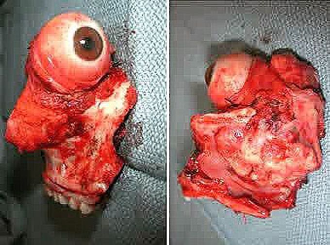 Orbitocranial-orbitomaxillary complex after en bloc resection!