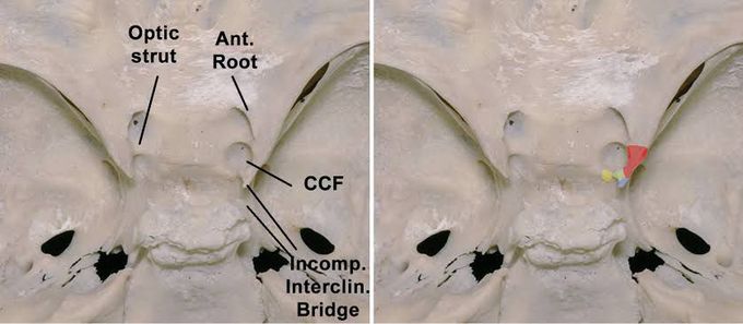 Clinoidectomy