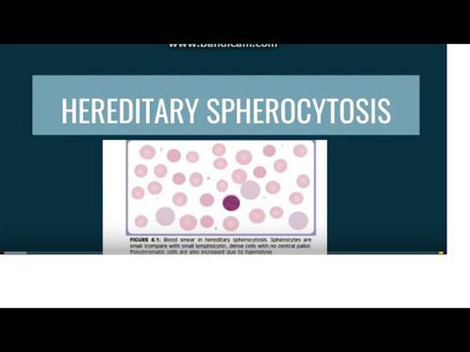 Simplified Pathology of Hereditary Spherocytosis