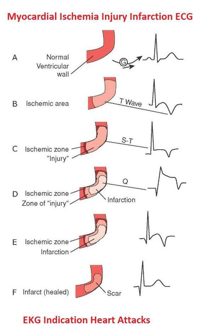 ECG of MI