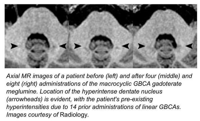 No signal intensity for pediatric patients with macrocyclic GBCA.