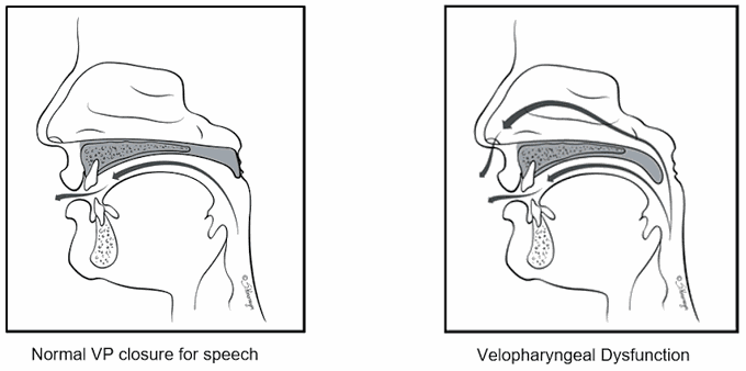 Treatment of velopharyngeal insufficiency