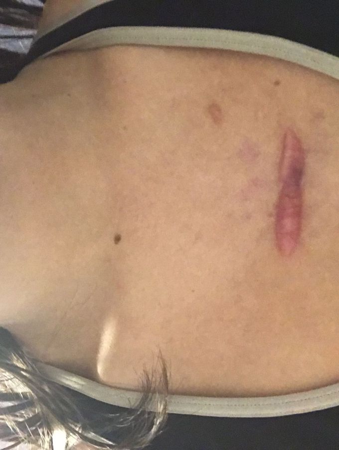 Severely hypertrophic scar after 2nd open heart