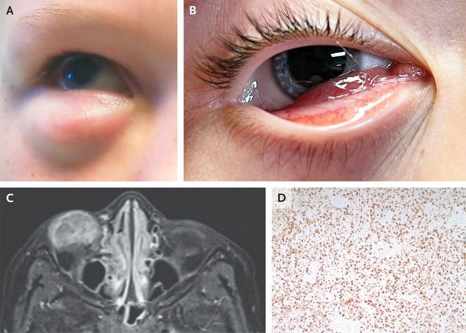 Orbital Rhabdomyosarcoma